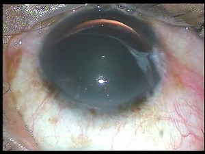 Intravitreal injection of Bevacizumab or Ranibizumab : Pradip Mohanta