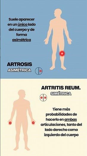Localización de la Artrosis y Artritis #artritis #artrosis #artritisreumatoide #sabiasque