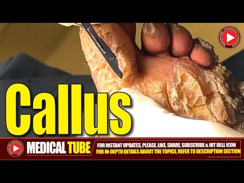 What is Callus? Shaving Callus on Entire Sole of Foot Treatment | Medical Tube