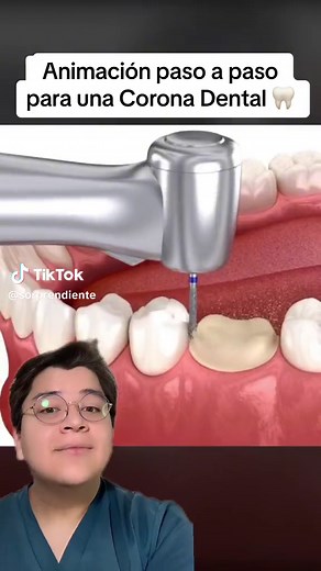 Animación paso a paso para la colocación de coronas dentales