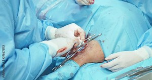 Closeup incision on the dog's leg, visible muscles and tissue, inserted needles, tweezers. Hands of male veterinarian, in white gloves and in surgical outfit, while he uses a surgical hammer into