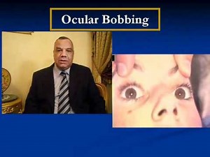 Ocular Bobbing
