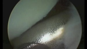 Wrist Arthroscopy: Synovectomy in RC Joint