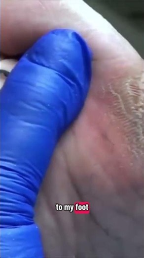 The Real Reason I Can't Ditch My Cane: Fear of Falling 😢 | Dr Nail Nipper #footcare #satisfying