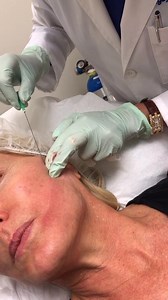 Jawline thread lift using PDO Threads