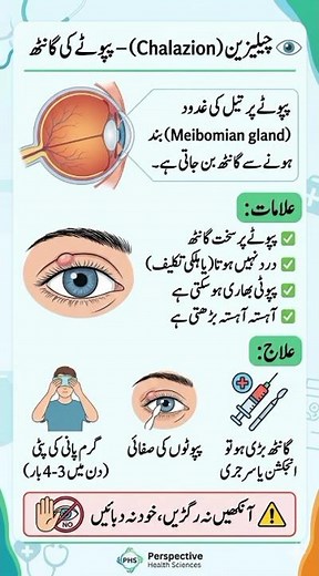 Chalazion – Eyelid Lump from Blocked Gland #chalazion #eyehealth