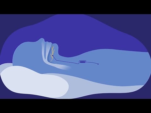 Hypoglossal Nerve Stimulation for Obstructive Sleep Apnea | David’s Story