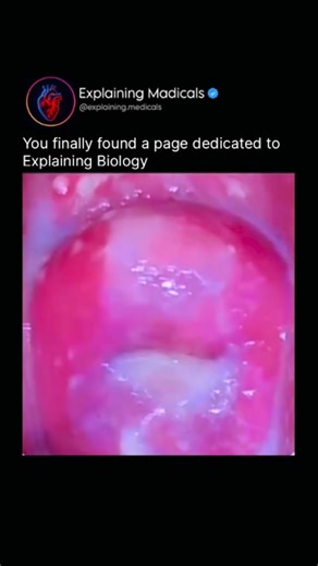 Medical | Health | Anatomy on Instagram: "Have you ever seen the difference between a healthy cervix and one with an infection? A normal cervix appears smooth, pink, and uniform, with a clean surface and minimal discharge. The tissue looks calm and intact, reflecting a healthy balance of bacteria and normal cell turnover. In contrast, a cervix affected by infection or inflammation can look red, swollen, irritated, or uneven. There may be excess discharge, mucus, small surface lesions, or areas t