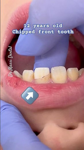 Chipped front tooth accidentally pulp exposure
