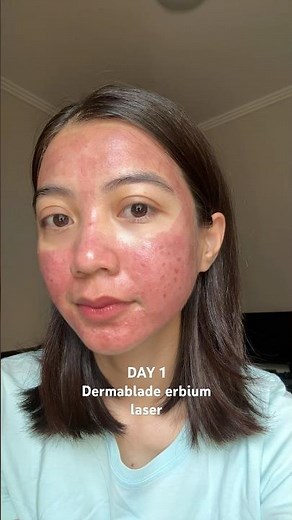 DAY 1 Scars treatment | Dermablade erbium laser #airinskinclinic
