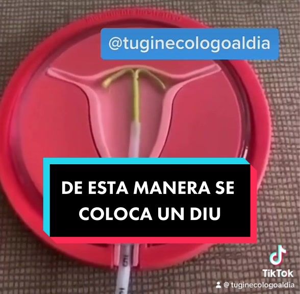 Hola Chicas cómo están? En este corto pero entretenido video, les traigo cual es la técnica que utilizamos nosotros los ginecólogos para colocar un DIU (Dispositivo intrauterino). El dispositivo lo colocamos dentro del aplicador, luego de medir el útero se introduce el aplicador por el orificio cervical hasta llegar dentro de la cavidad uterina donde dejamos directamente el dispositivo para proceder posteriormente a retirar el aplicador y por último cortar los hilos del dispositivo. Parece ser u