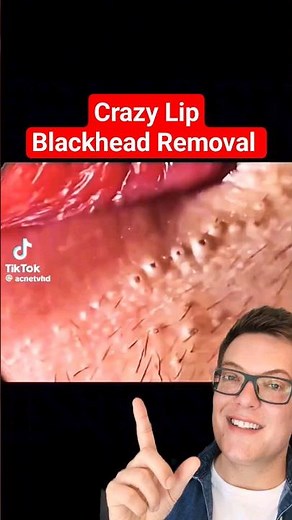 Super Satisfying LIP BLACKHEAD REMOVAL - Why All The Hairs #shorts