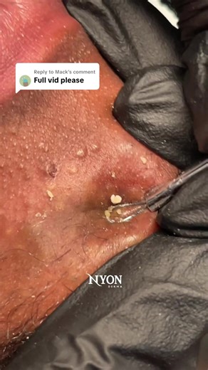 Replying to @Mack At Nyon Derma, we don’t just pamper your skin — we purify it. 💆🏽‍♀️ During your facial, we gently perform extractions to clear out: 🖤 Blackheads 🤍 Whiteheads 💧 Trapped oil 🧼 Dirt and buildup This step helps your pores breathe again, prevents future breakouts, and allows our active ingredients to penetrate deeper and work better. No harsh squeezing. No guesswork. Just clean, safe, professional care — so your skin leaves healthier, smoother, and glowing with confidence. ✨ Y