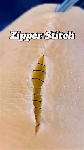 Vetventures on Instagram: "Zipping Up Skin with Intradermal Sutures 😷 Get your suture kit from vetventures-shop.fourthwall.com (worldwide shipping 🌎🌍🌏) Link in bio ⬆️ #medicalinstagram #surgeonsofinstagram #suturing #medicalstudent #vetstudent"