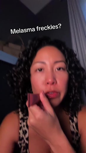 Understanding Melasma and Effective Treatments