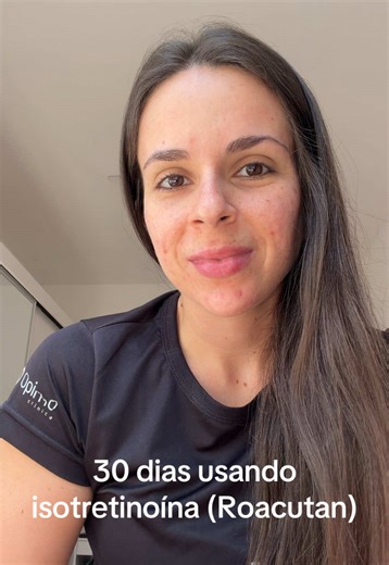 Isotretinoína: Evolução do Tratamento com 30 Dias