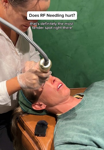 Ever wondered what RF Needling really feels like? Get the inside scoop from some of our amazing clients in clinic! 💓 #rfneedling #theskinbar #skintreatments #sydney