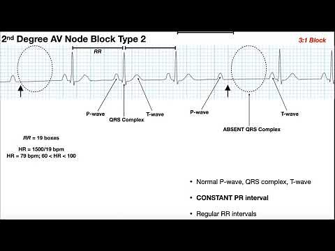 EKG Patterns | 1st & 2nd Degree AV Node Blocks