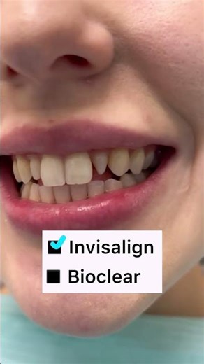 Invisalign plus no prep Bioclear for the win! Come to Pinellas County’s certified Bioclear dentists.