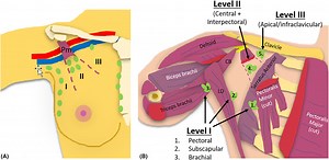 Sonographic localisation of lymph nodes suspicious of metastatic breast cancer to surgical axillary levels