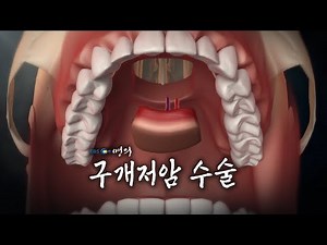 [Medical Encyclopedia📖] Palate Cancer Surgery