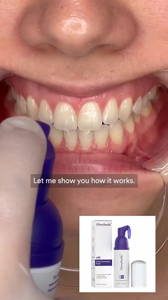 Glorysmile V34 Teeth Whitening Foam Overview