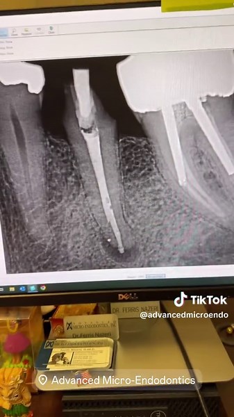 Endodontic Retreatment of Tooth #20 Explained