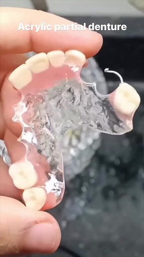 Partial denture made only from acrylic and a single metal clasp. Holds less than a metal/acrylic partial but it’s a good temporary option. | Dr Anto Youssef