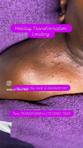 DPN Treatment on Neck & Décolleté #dpntreatment #dpn #blackesthetician #skintransformation