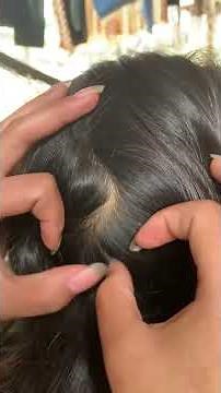 (Part 232) Removing Lice by Hand Satisfying Lice #lice #liceremoval #shortsfeed #shorts #shortsviral