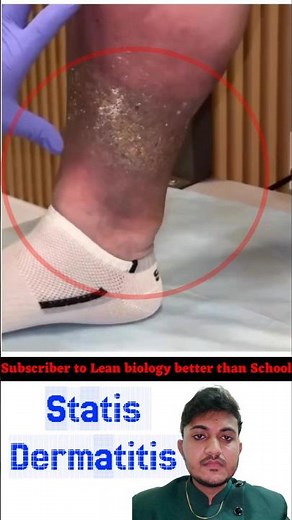 dermatitis ❤️ #dermatitis #skinallergy #varicoseveins