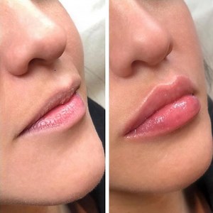 Lip threading is the new non-surgical cosmetic trend for a plumper pout - and the results are impressive