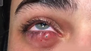 Styes may require surgical intervention to drain the pus and alleviate pressure