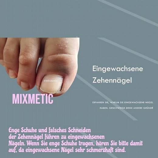 Eingewachsener Fußnagel oder Zehennägel und wie kannst du das verhindern Tip 1 #foot #pedicure #spa