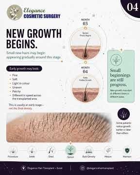 Hair Transplant Recovery Timeline | What to Expect Month by Month