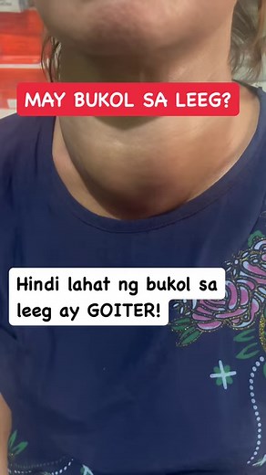 201K views · 348 reactions | Hindi lahat ng bukol sa leeg ay goiter? Paano ito malalaman? Karaniwan nagre request kami ng neck ultrasound at kung ito ay goiter, isinasama na namin ang thyroid function determination ( FT3,Ft4, TSH)! #thyroid #goiter #thyroidhealth | Irma Antonio-Pilar MD/ Diabetes and Thyroid Specialist | Facebook