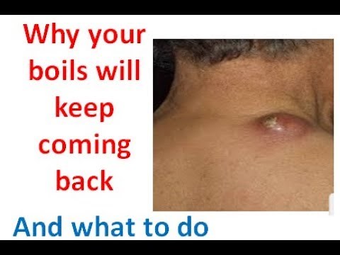 Boils keep coming back? here are what causes recurring boils & how to get rid of it permanently