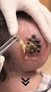 OMG 😱 Huge blackheads removal! #blackheadsremove #foryou #treandingvideo #viralvideo