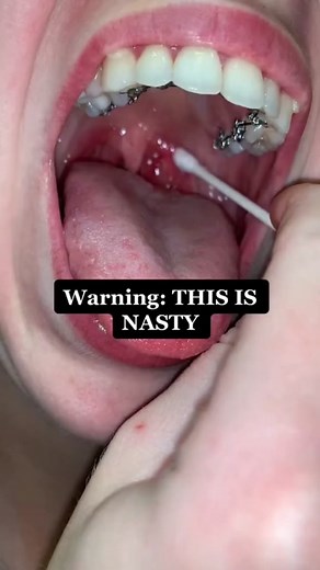 Introducing the Ultimate Tonsil Stone Remover: Something Nice Water Flosser