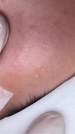 ✨ Milia Removal — Tiny Bumps, Smooth Skin Milia are small, white bumps that often don’t disappear on their own. They’re not pimples or acne. Milia are tiny keratin-filled cysts that commonly appear around the eyes, cheeks, and forehead. ✨ During the procedure: ✔️ Carefully and hygienically remove the milia ✔️ Minimize unnecessary skin trauma ✔️ Reveal smoother, cleaner-looking skin ❗ Avoid removing milia yourself. Squeezing or picking can lead to irritation, inflammation, scarring, or pigmentati