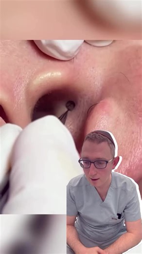 What do you think this is? #blackhead #blackheadremoval #blackheadremover #blackheadextraction #satisfyingremoval