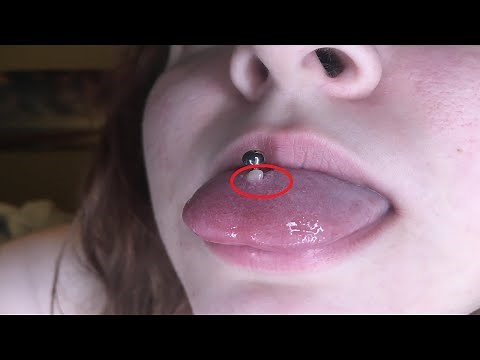 how to get rid of a tongue piercing bump