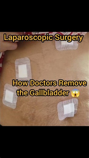 Gallbladder stone surgery ke din mai kaise gayi hospital #viralvideo #shortvideo #minivlog #shorts