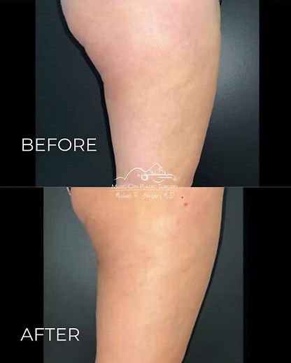 ✨ Before & After | Inner Thigh Lift (Thighplasty) in Nashville⁠