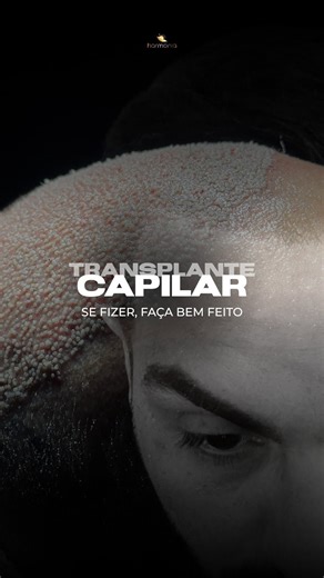 Clínica Harmonia on Instagram: "🔔 Estamos em férias coletivas do dia 18/12/2025 até o dia 11/01/2026. Nosso atendimento em todos os canais de comunicação retornarão somente no dia 12/01/2026. 👉🏻 Na hora de escolher uma clínica para mudar o seu visual, tome cuidado e se atente a detalhes importantes para que seu procedimento seja um sucesso. Por isso, o lugar certo é a Clínica Harmonia! ✨ Realizamos 3 transplantes diariamente. Mais de 7.000 transplantes realizados! CRM/RS 11664 RT: Dra Mariana