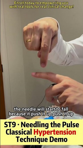 ST9 Needling the Pulse” – Classical Hypertension Technique Demo