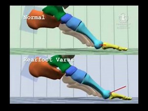 Comparison of Normal Gait to Rearfoot Varus Gait