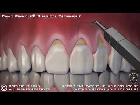 Chao Pinhole® Surgical Technique