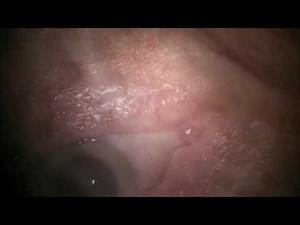 Dextenza Intracanalicular Insert Instructional Video - Dr. Paul Singh