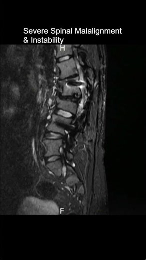 Severe Spinal Malalignment & Instability (TPSF Evaluation) Sagittal T2 #MRI #Radiology #Shorts